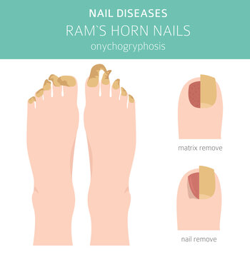 Nail diseases. Onychogryphosis, Ram`s horn nail. Medical infographic design