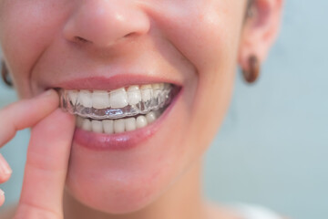 Woman putting on her invisible silicone aligner. dental correction. mobile orthodontic