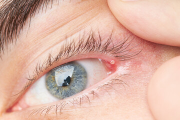Fototapeta na wymiar eyelid pimple macro close up. pimple near eye. hygiene problem