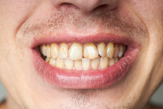 male patient mouth with tooth disease. hygiene and orthodontic problem