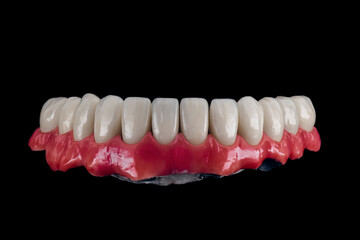 all on six dental ceramic restoration on implants