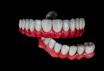 all on six dental ceramic restoration on implants