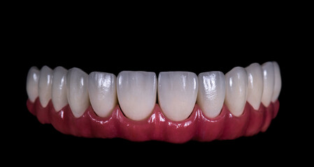 all on six dental ceramic restoration on implants