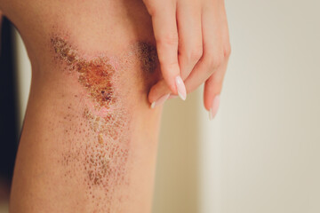 two scratch wound on female knee with big scar closeup, healthcare and medicine concept.