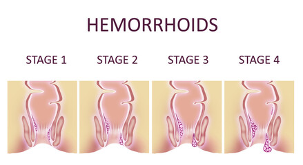 Hemorrhoid stages. Illustration of unhealthy lower rectum with inflamed vascular structures, banner design