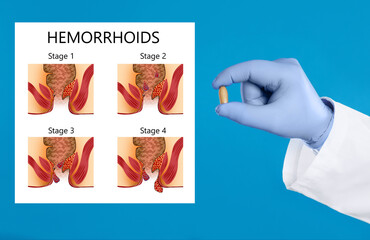 Doctor holding suppository for hemorrhoid treatment near illustration of lower rectum progressing disease, blue background
