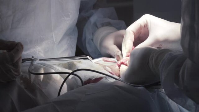 Close up detail of a surgery on male genitals with the professional equipment. Action. Surgeons in sterile suits performing medical procedure, process of prostatectomy.