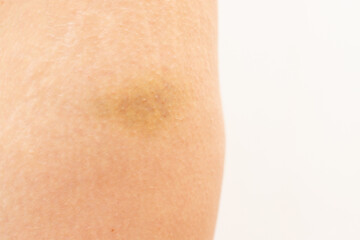 The result of domestic violence. Bruise on the leg