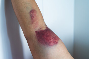 Fototapeta premium Bicep tear or strain, tendon injuries on a muscular man hand. Trauman or trauma injury. Health and medical and fitness concept.