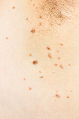 Papilloma virus in the armpit of a man, a dermatological problem, the concept of skin disease.