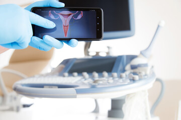 Ręka lekarza w niebieskiej rękawiczce pokazuje na monitorze telefonu ilustrację szyjki macicy.  - obrazy, fototapety, plakaty