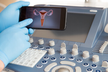Ręka lekarza w niebieskiej rękawiczce pokazuje na monitorze telefonu ilustrację szyjki macicy.  - obrazy, fototapety, plakaty