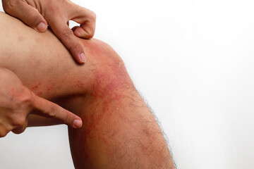 Close up dermatitis on skin, ill allergic rash dermatitis eczema skin of patient , atopic...