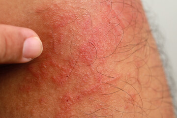 Close up dermatitis on skin, ill allergic rash dermatitis eczema skin of patient , atopic dermatitis symptom skin detail texture , Fungus of skin ,The concept dermatology.