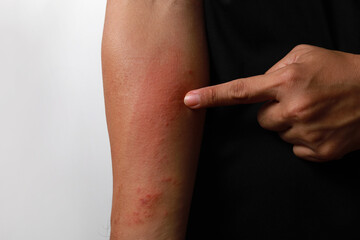 Close up dermatitis on the skin, ill allergic rash dermatitis eczema skin of a patient, atopic...