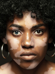 Portrait of african-american woman with vitiligo skin. Special skin with depigmentation because of melanin losing. Concept of skincare and healthcare, inclusion and diversity, fashion and beauty.