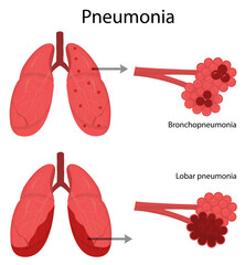 Lung disease. Pneumonia.