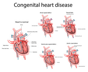 Congenital heart disease. Heart disease - obrazy, fototapety, plakaty