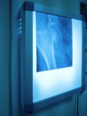 Glowing negatoscope with x-ray of femur fracture and pelvic bones