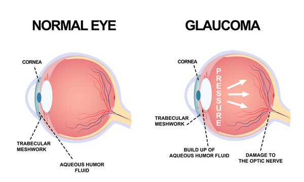 Eye structure. Anatomy of an eye defect, Glaucoma