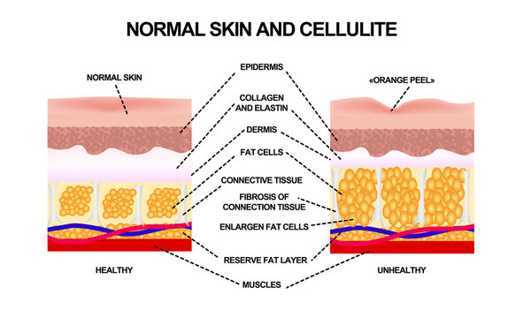 Normal skin and cellulite. Vector illustration with symbols