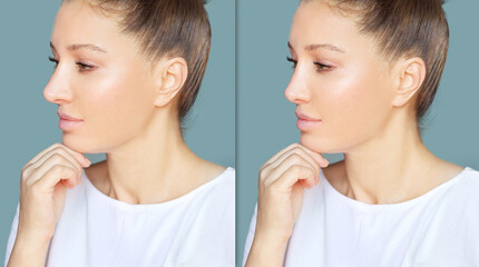 Rhinoplasty.Before and after	
