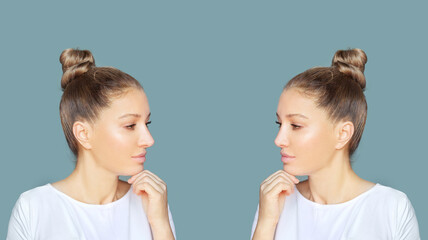 Rhinoplasty.Before and after	
