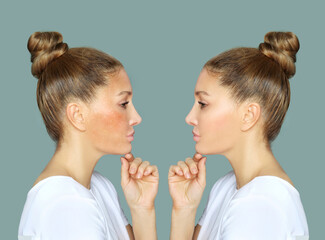 Dark spots, freckles,hyperpigmentation(melasma or chloasma)	