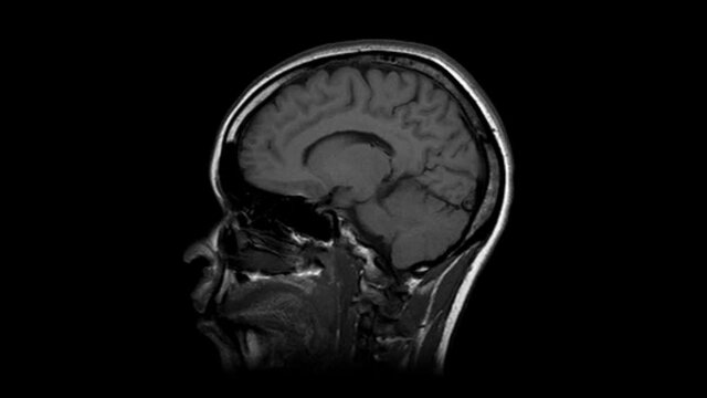 Time lapse of MRI brain scan, timelapse of monochrome magnetic resonance imaging of a human head. Stop motion side view of CT scan with anatomical details. Seamless loop animation of the human head.