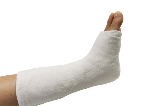 Leg bandaged in a plaster cast for fracture of the leg and ankle joint, isolate on white background. Patient with broken leg from the accident and splints for treatment.