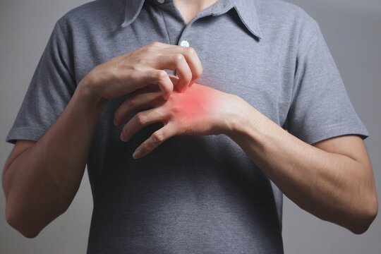 Hand-scratching, Itching of skin diseases with young female and have red around the Itching area. Concept Healthcare.