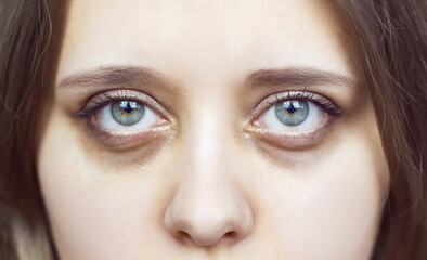 Cropped shot of a young female face. Green eyes with dark circles under the eyes. Bruises under the...
