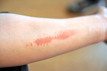 thermal  , steam burn scar skin of female hand