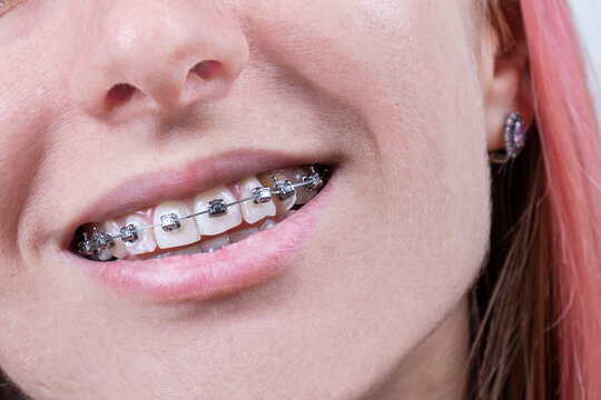 Beautiful of teeth with braces. Dental care photo. Young woman smile with orthodontic accessories. Orthodontics treatment.