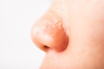 Fototapeta premium Closeup Asian young woman large pores have freckles cheek oily, acne pimple on nose, studio shot isolated on white background, Healthcare beauty skin face problem concept