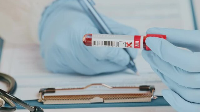 Doctor or laboratory technician holds in hand laboratory positive blood sample for HIV test, hand writing results to patients medical record. Laboratory medical diagnostics. World AIDS Day concepts