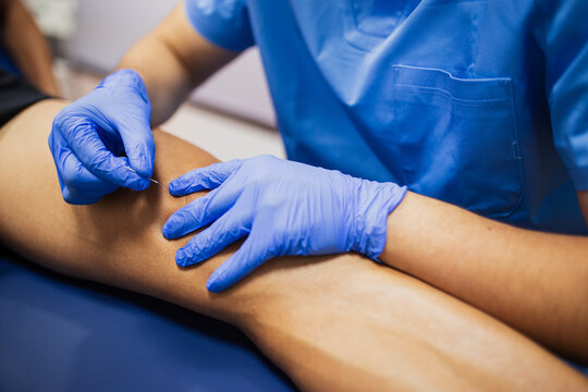 From above of crop faceless sports medicine doctor in sterile gloves inserting thin needle in leg of unrecognizable male patient in underwear lying on examination couch during acupuncture process