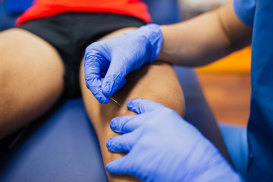 From above of crop faceless sports medicine doctor in sterile gloves inserting thin needle in leg of unrecognizable male patient in underwear lying on examination couch during acupuncture process