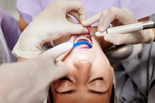From above of crop patient with braces having cleaning procedure in modern dental clinic