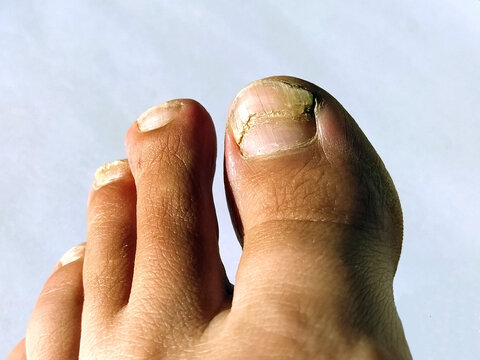 A toenail fungus at the peak of the infection. Painful toe contagious with onychomycosis. Active phase of the disease. untreated onychomycosis of the feet