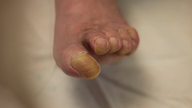 Long overgrown toenails of an old man