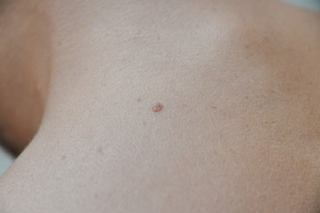 Fototapeta premium Skin diseases irritation, itching, cracked wounds lead to painful sensations. The skin may grow papillomas, warts, moles, white and dark spots will appear.