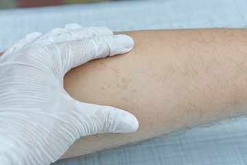 Skin diseases irritation, itching, cracked wounds lead to painful sensations. The skin may grow papillomas, warts, moles, white and dark spots will appear.