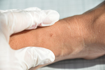 Skin diseases irritation, itching, cracked wounds lead to painful sensations. The skin may grow papillomas, warts, moles, white and dark spots will appear.