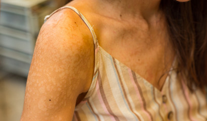 White caucasian women with skin problem disease in garden, perfectly imperfect girl