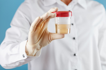 A doctor in a white coat holds a plastic container with yellow urine in his hand.
