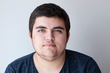 Obraz premium Studio portrait of a young man on gray background posing. Puberty theme, problem skin, teen acne.