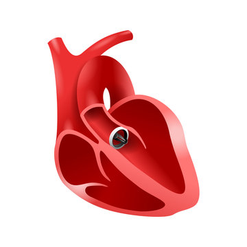 Artificial heart valve (aortic bileaflet) implanted into heart to replace a disfunctional native valve