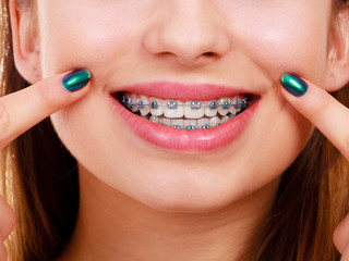 Woman showing her teeth with braces