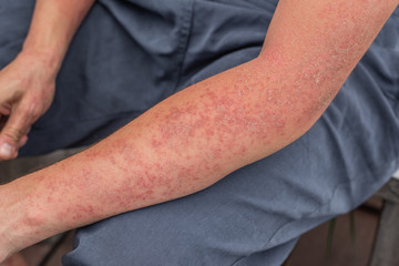 Dyshidrotic autoimmune eczema of patient. Concept of health care